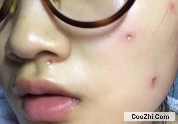 点痣要注意什么吗优质