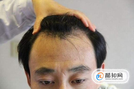 天生发际线高还有救吗？优质